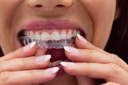 Invisalign vs. Traditional Braces: Which Treatment is Right for You, According to Your Dentist